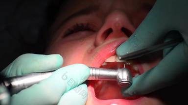 年轻的女孩牙齿固定牙医的<strong>龋齿</strong>清理准备填充应用程序关闭